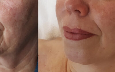 Welche Ergebnisse kann ich mit der Microdermabrasion erreichen?