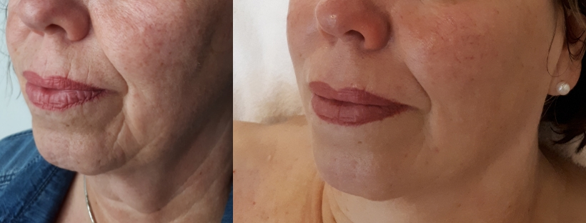 Welche Ergebnisse kann ich mit der Microdermabrasion erreichen?