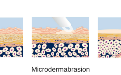 Microdermabrasion