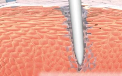 Microneedling