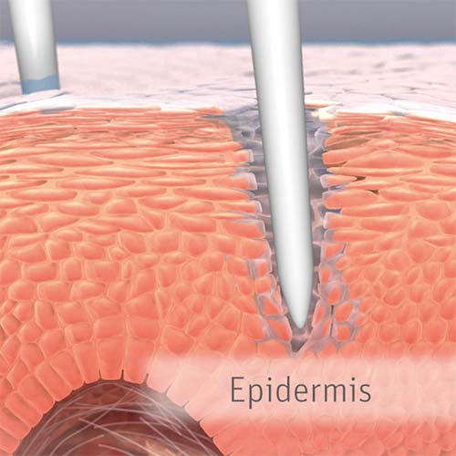 Microneedling