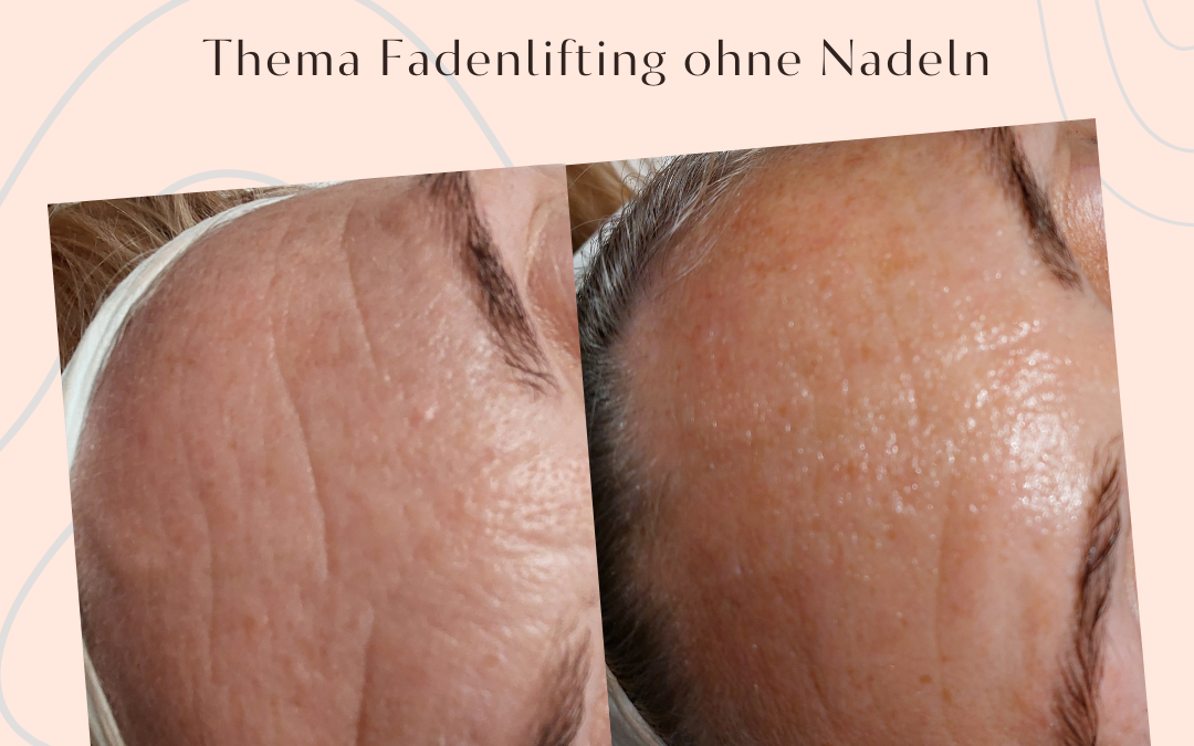 Neu! Fadenlifting ohne Nadeln